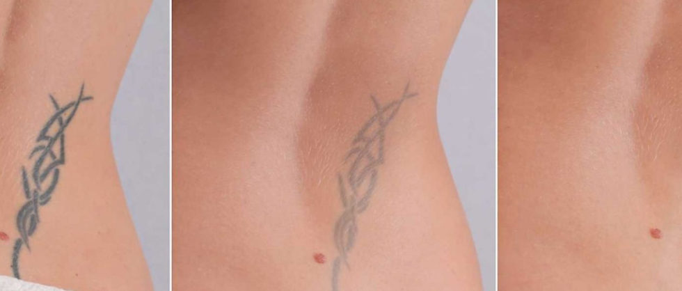 Laser Tattoo Removal Sandy Milgraum MD NJ Dermatology